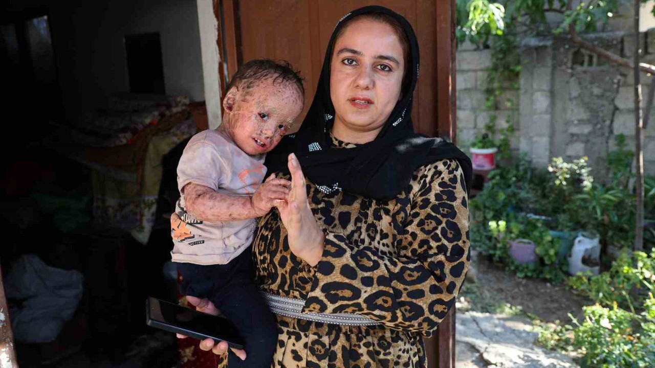 Balık pulu ve kelebek hastası Yusuf’un yardım paralarını dolandırıcılar topladı
