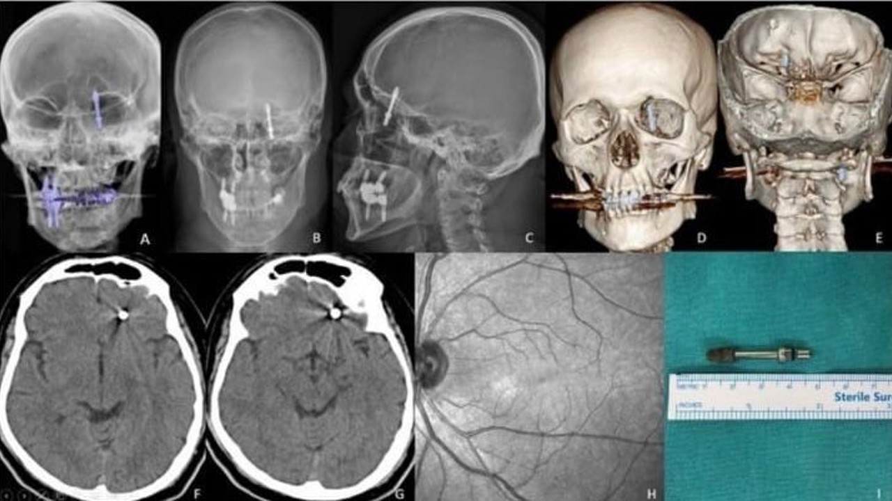 Beynine saplanan implant hayatını kararttı: 2 yıldır adalet bekliyor
