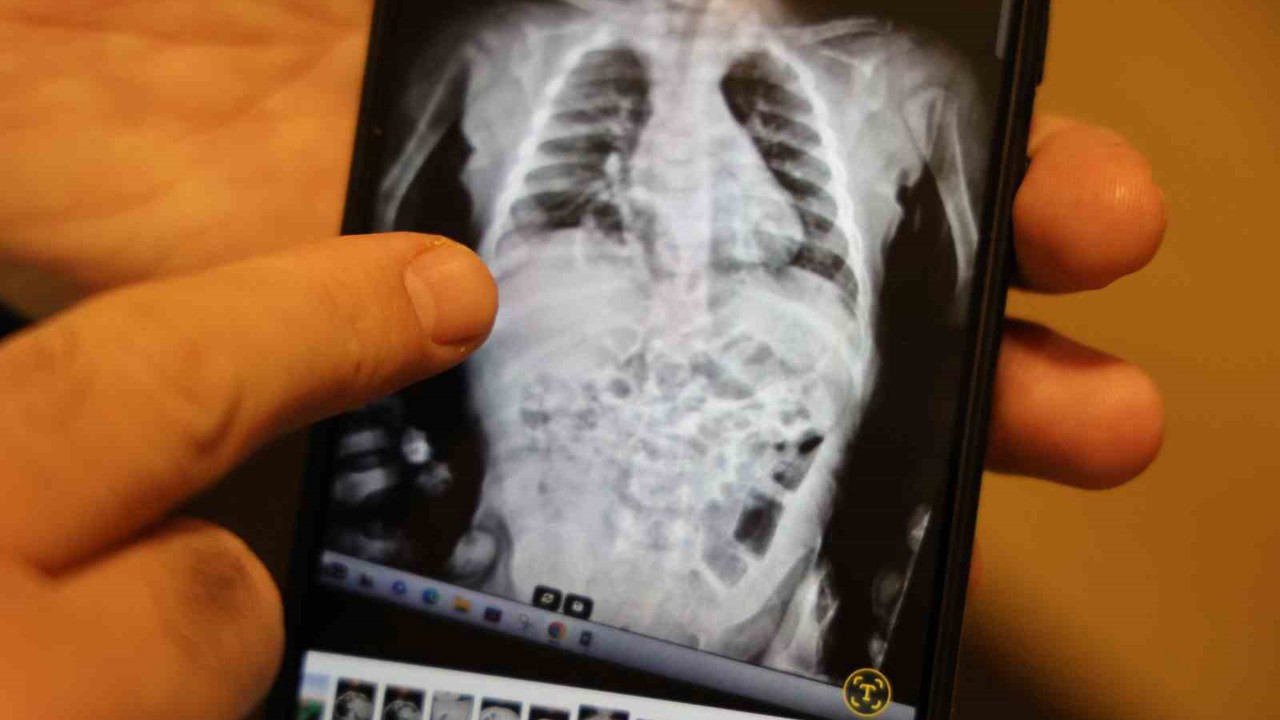 Doğuştan 200 binde bir görülen hastalıkla 2 yıl boyunca yaşayan çocuk sağlığına kavuştu
