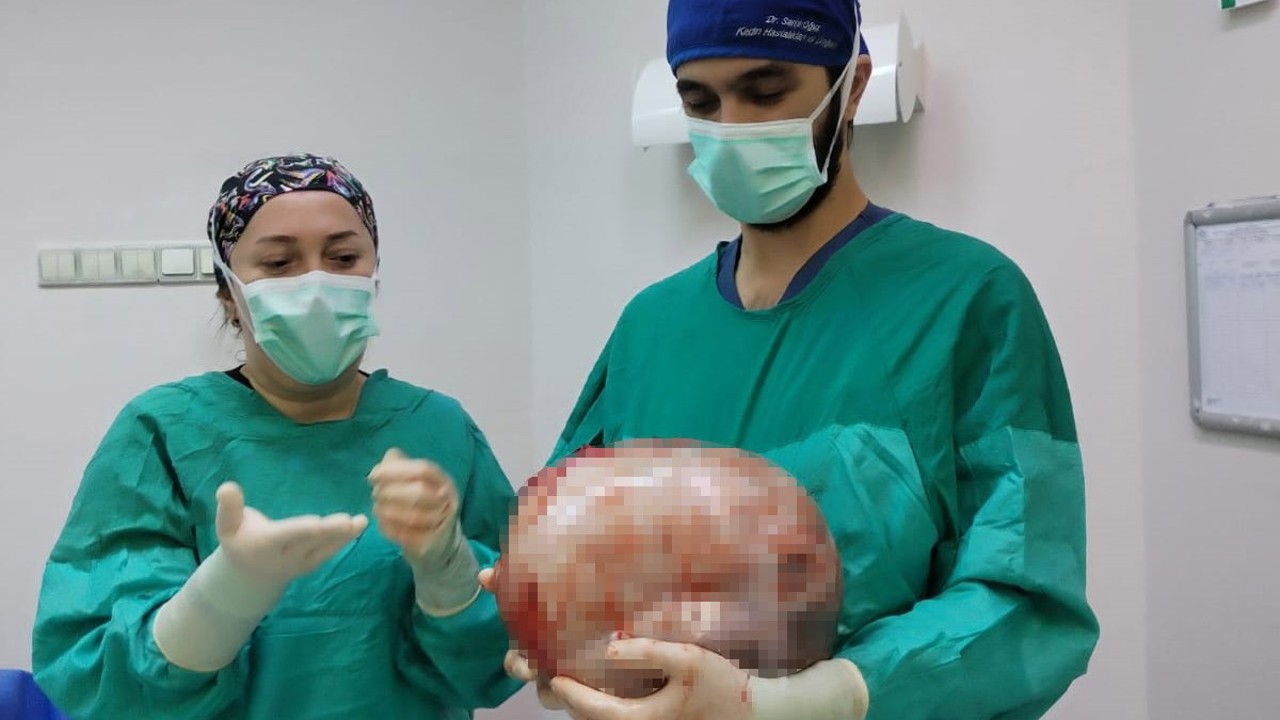 Karnı 2 ayda 9 aylık hamile gibi büyüyen kadının içinden karpuz kadar kitle çıkarıldı
