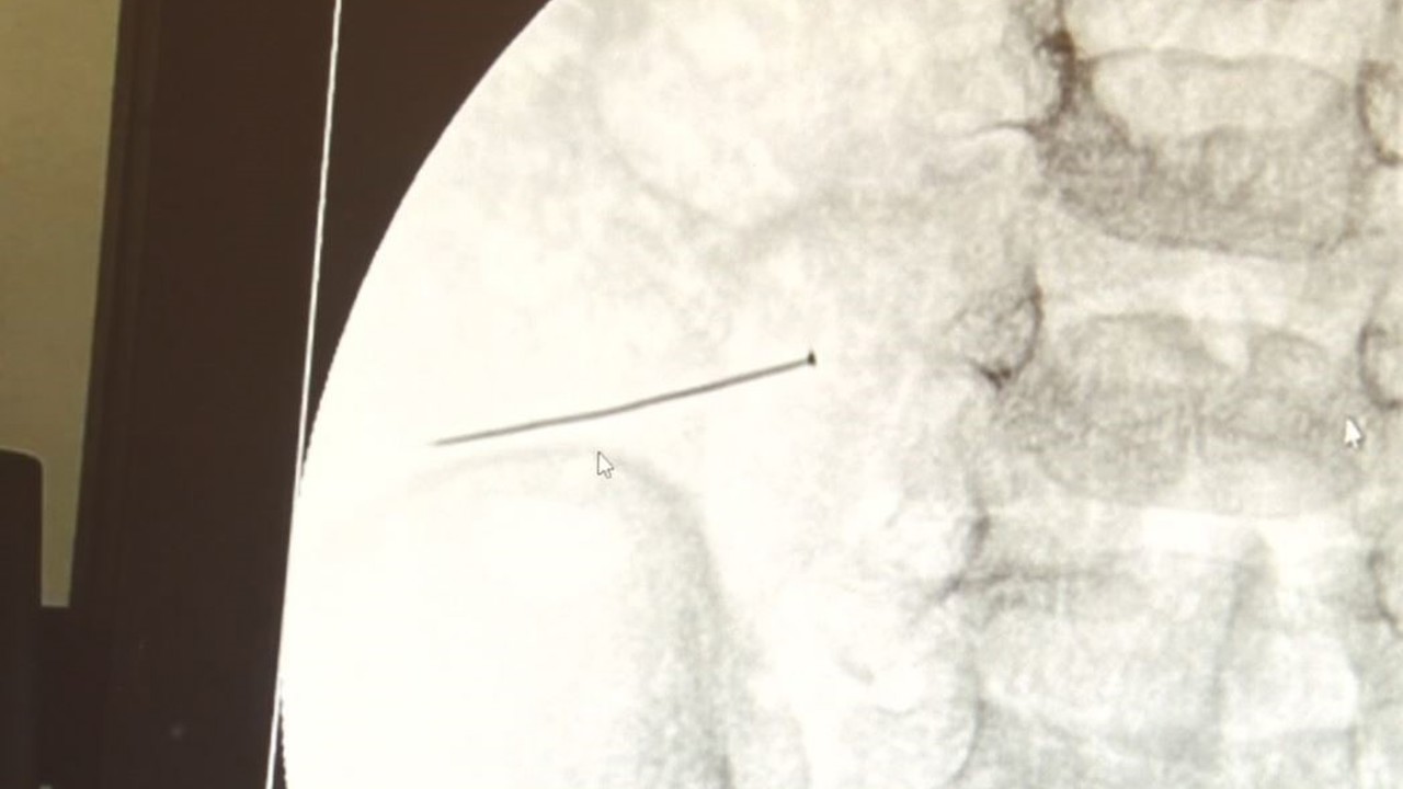 Ağrıyla kıvranan 2 yaşındaki çocuğun bağırsağından 3 santimlik iğne çıktı
