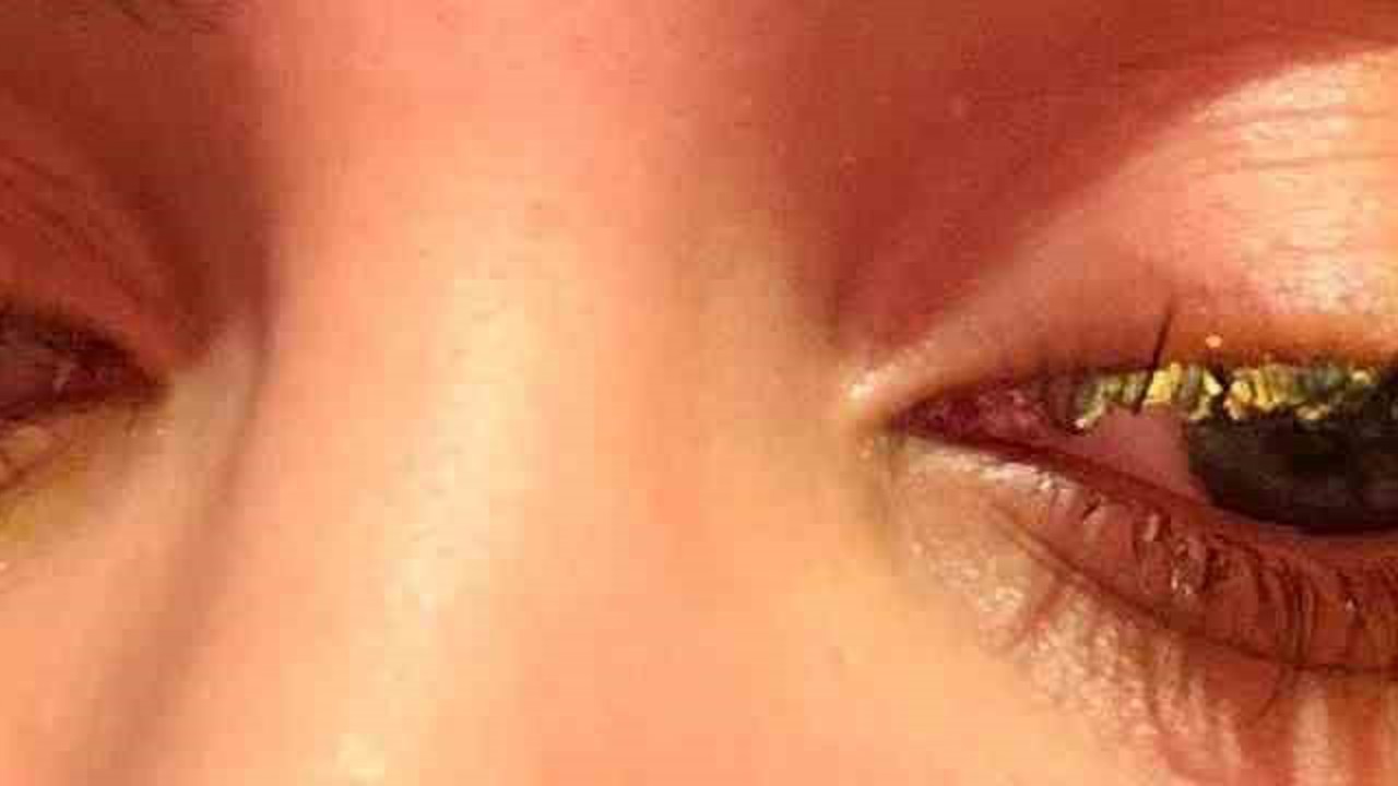 Güzellik merkezinde genç kadının gözüne yapıştırıcı kaçtı: "Kör olabilirdim"
