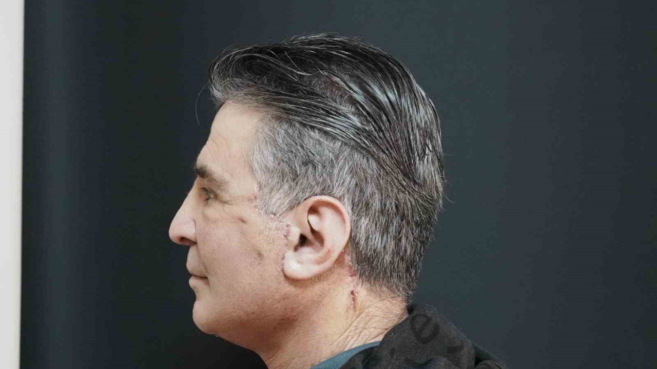 Bitlis’te ilk defa yüz germe ameliyatı başarıyla yapıldı
