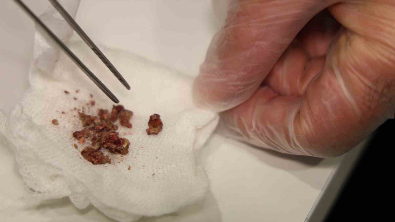 Elazığ’da estetik ameliyatta şaşırtan olay, burundan taş çıktı
