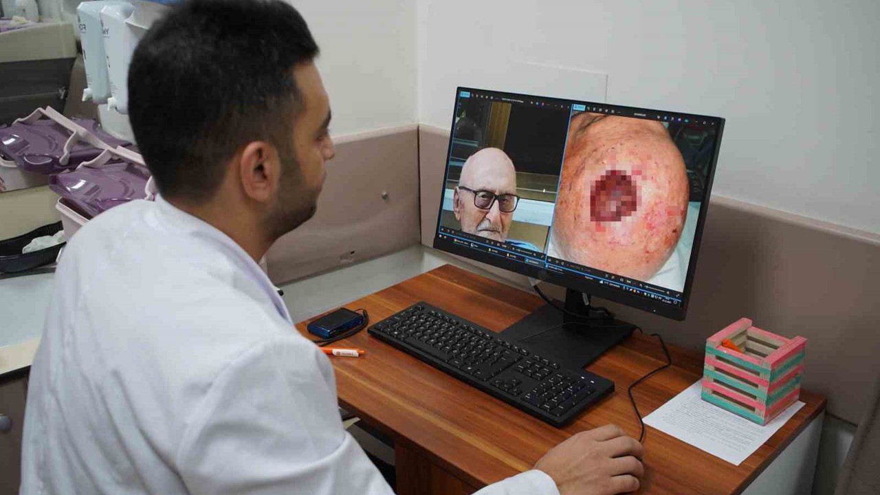 Dünyada 3’üncü kez rastlandı: Saçlı derideki nadir tümör Sakarya’da tedavi edildi
