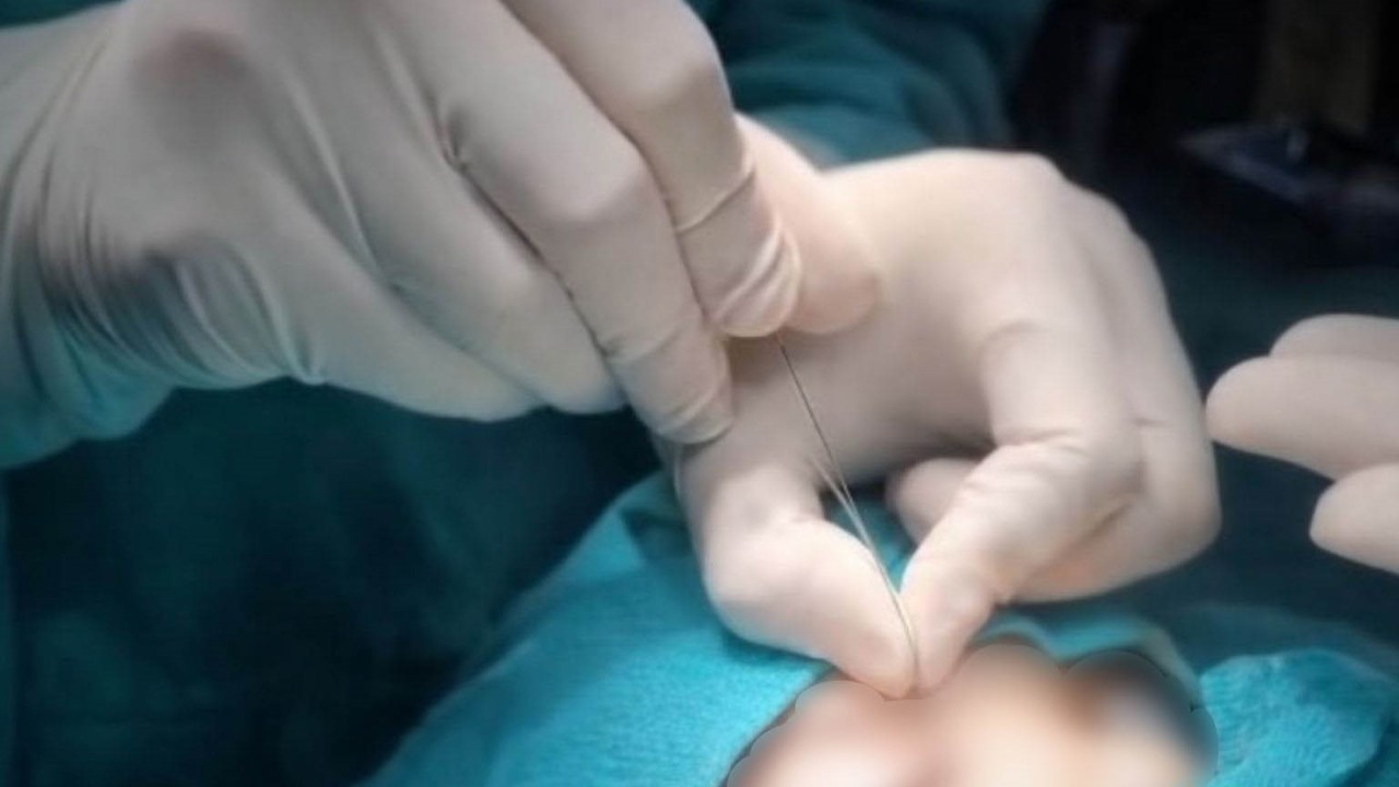 Çukurca’da gözyaşı kanalı ameliyatları yapılmaya başlandı
