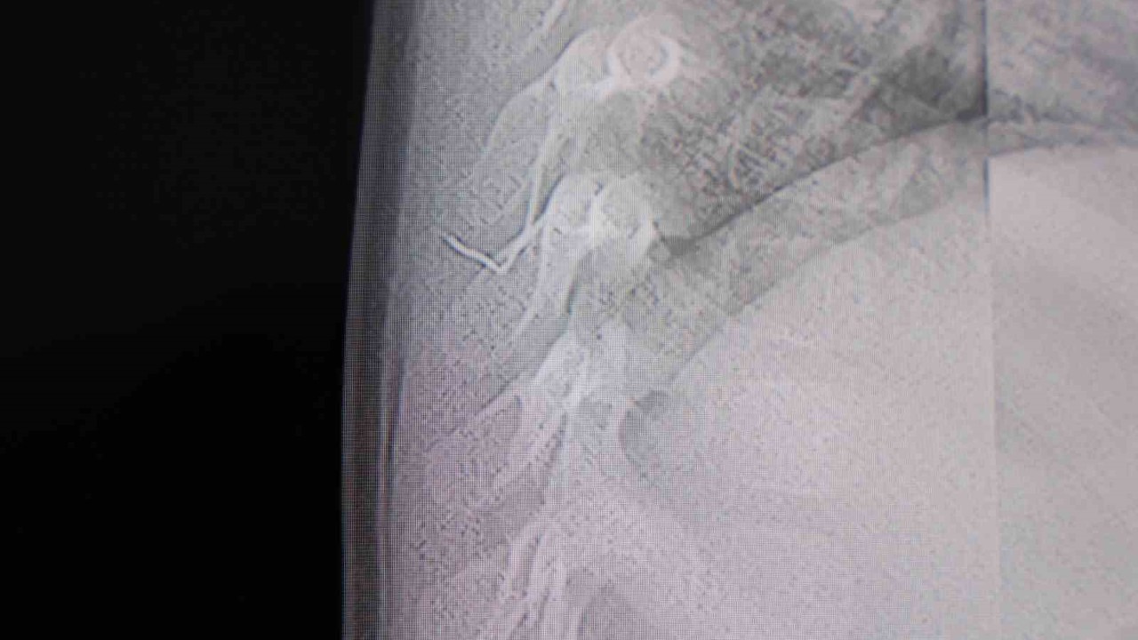 Bebeğin sırtından tel parçası çıktı
