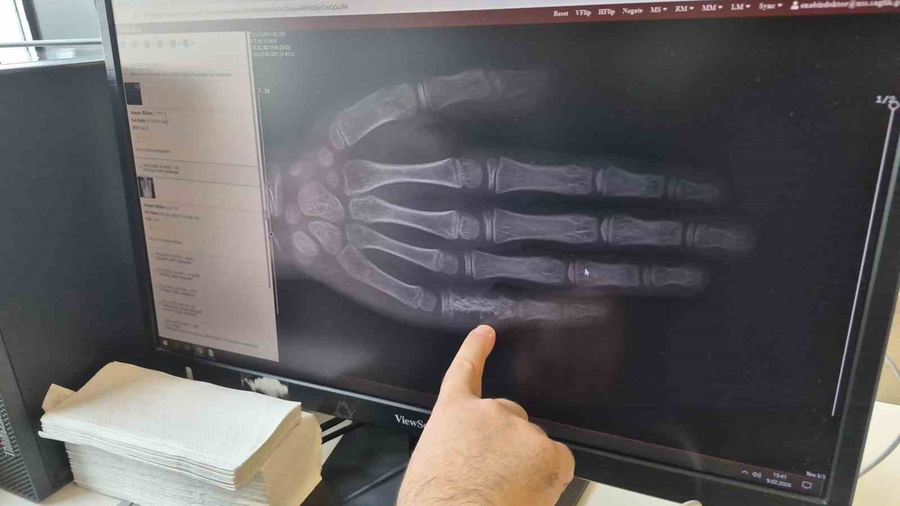 Eskişehir’de her ay 5 ila 7 çocuğa kanser tanısı konuluyor
