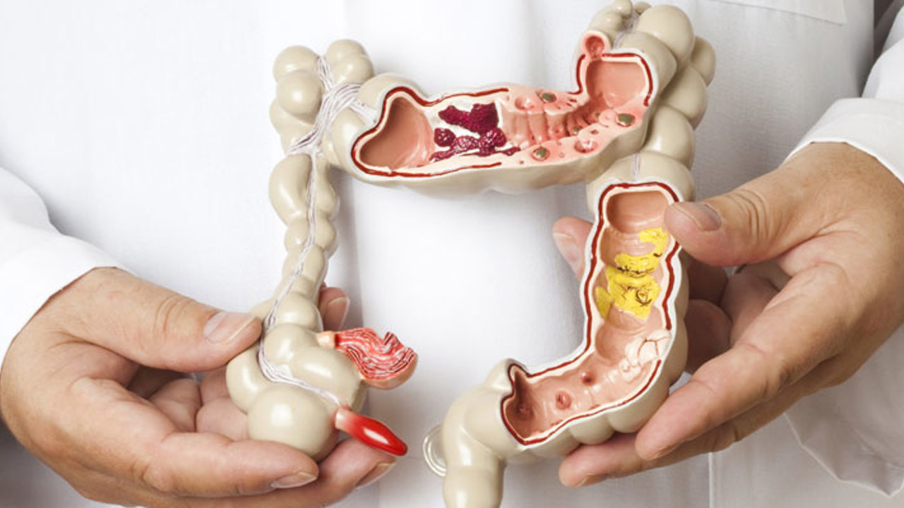 Kolon Kanseri Bu Yöntemle Önlenebiliyor!