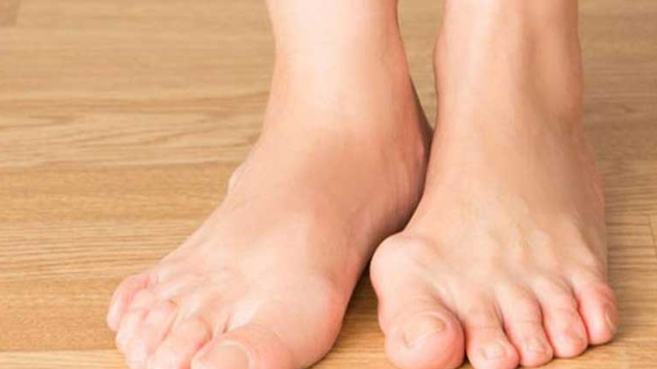 Halluks valgus yaşam kalitesini önemli ölçüde etkileyebilir