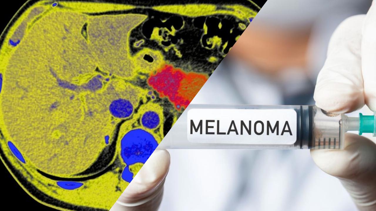 Kişiye özel kanser aşısı, melanomun tekrarlama riskini yüzde 42 azalttı
