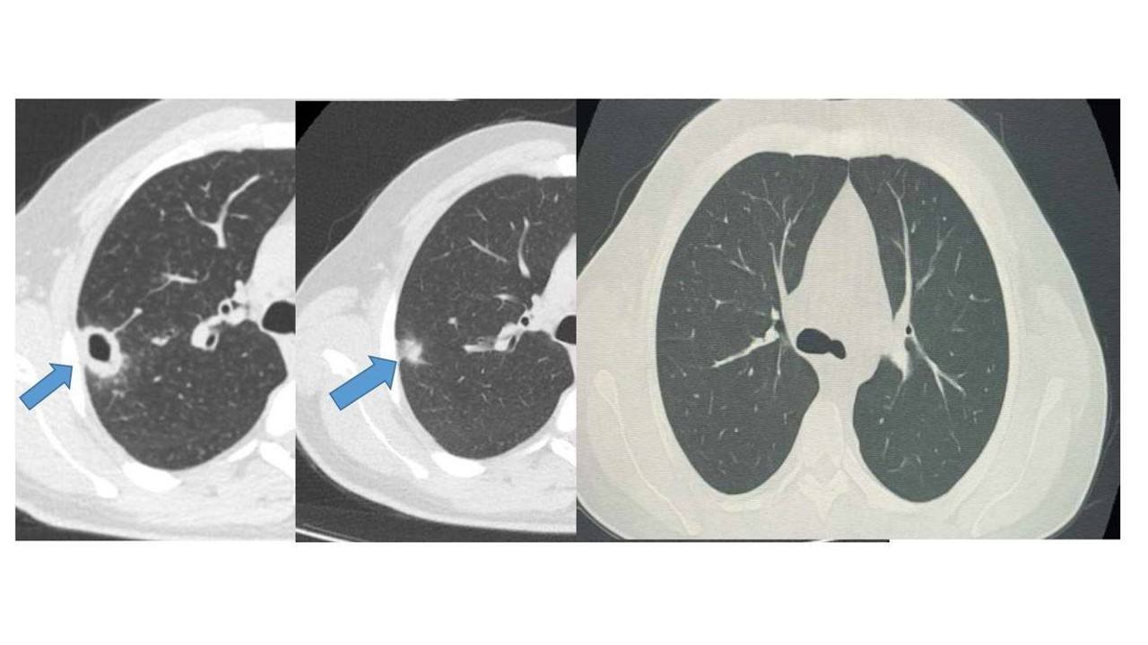 Bayburt’ta 50 yaşındaki hasta erken tanıyla sağlığına kavuştu
