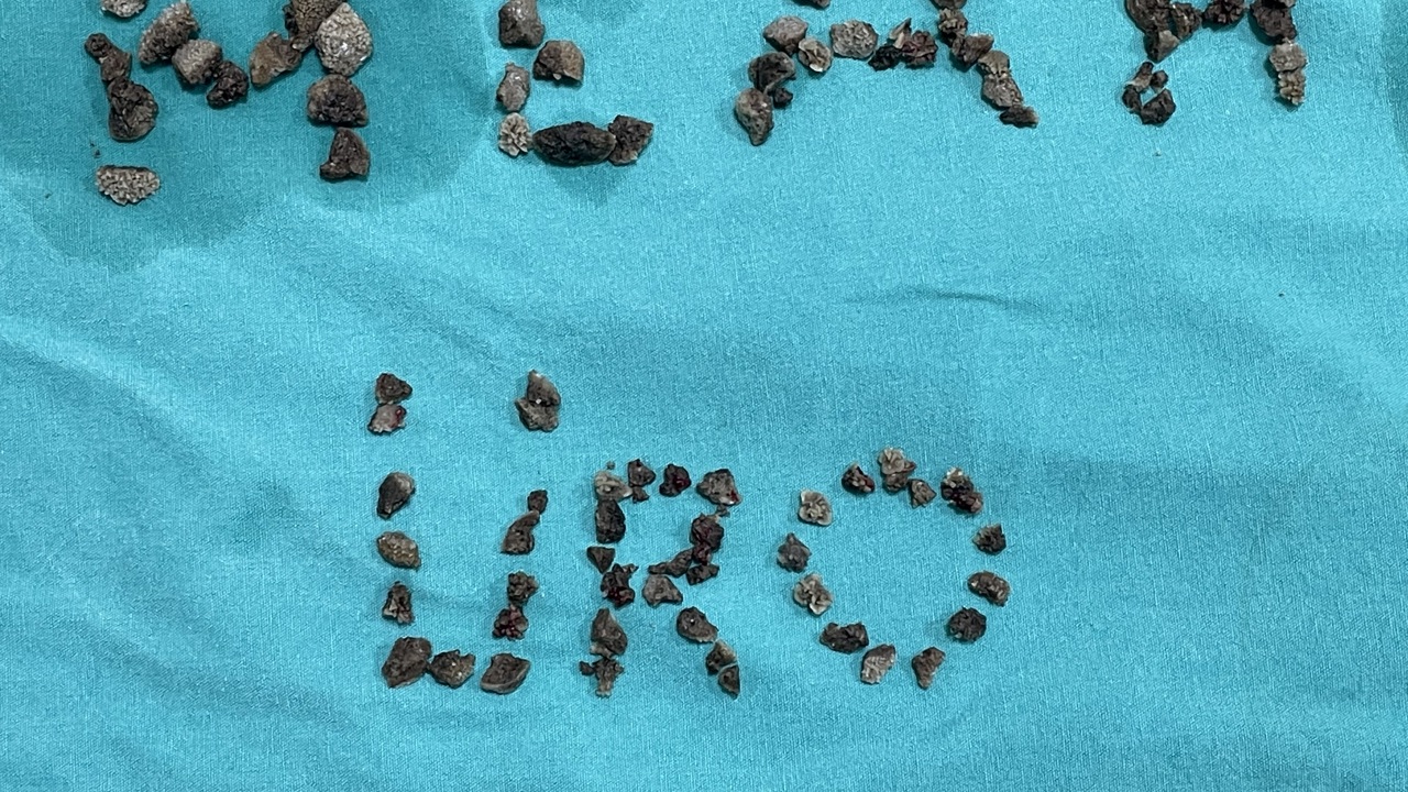 Malatya’da 8 Santimetrelik Böbrek Taşı Kapalı Yöntemle Alındı