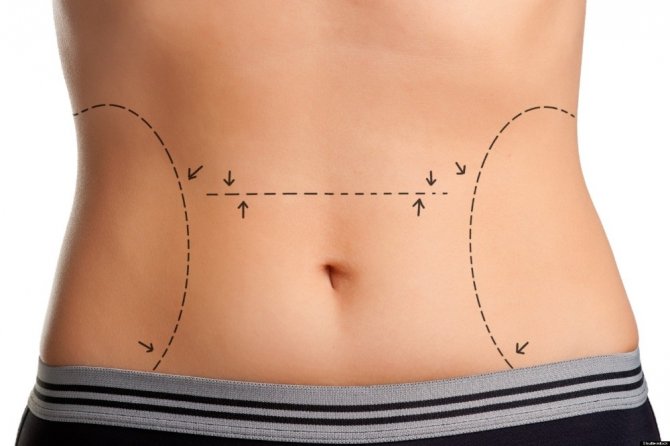 Doç. Dr. Karaca Başaran: “Liposuction zayıflama yöntemi değildir”